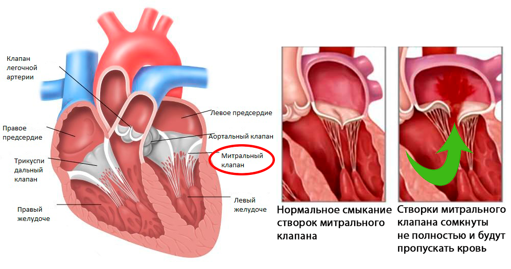 недостаточность митрального клапана